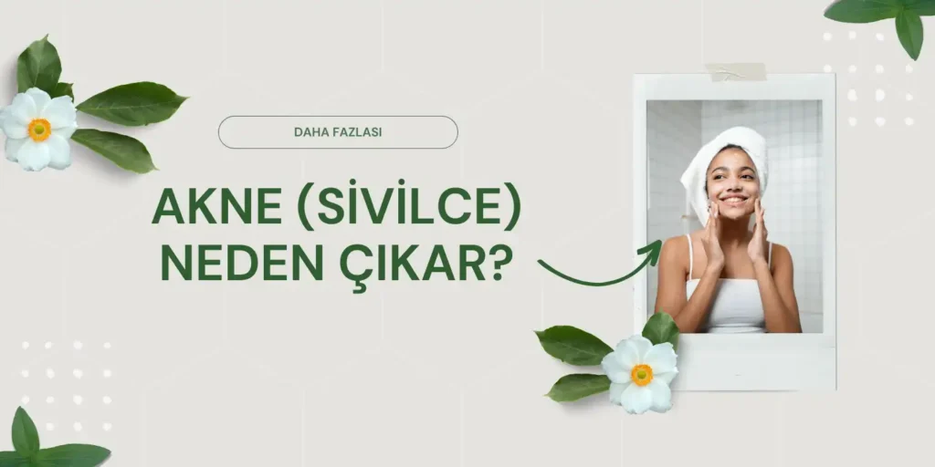 Akne (Sivilce) Nedir 5